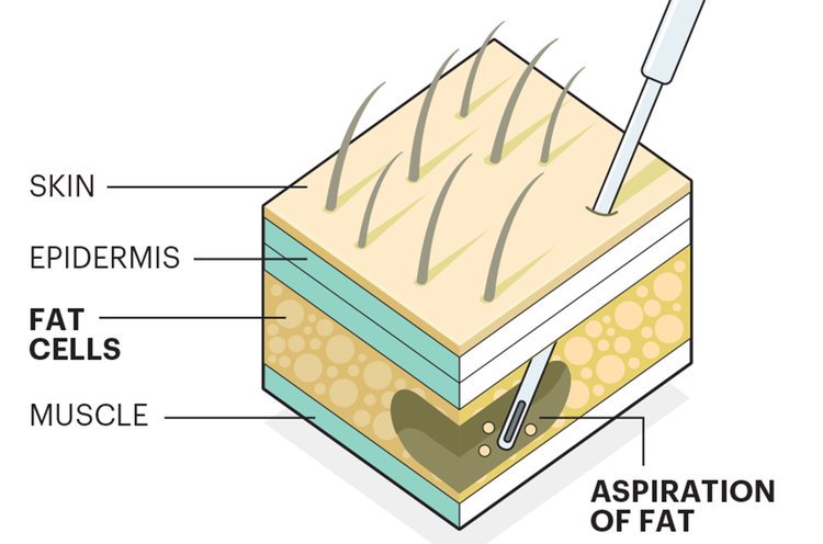 1140-fat-harvesting-stem-cells.imgcache.rev560947f.jpg